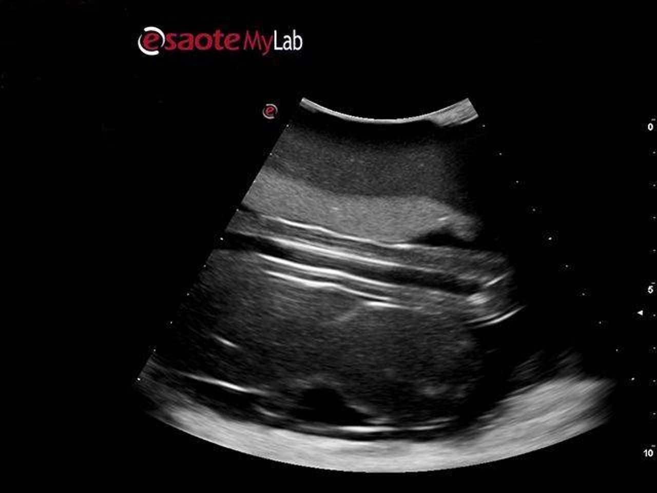 Percutaneous Umbilical Cord Blood Sampling Ultrasound Training Model