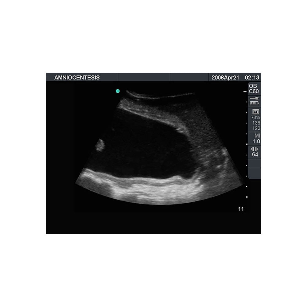 Percutaneous Umbilical Cord Blood Sampling Ultrasound Training Model