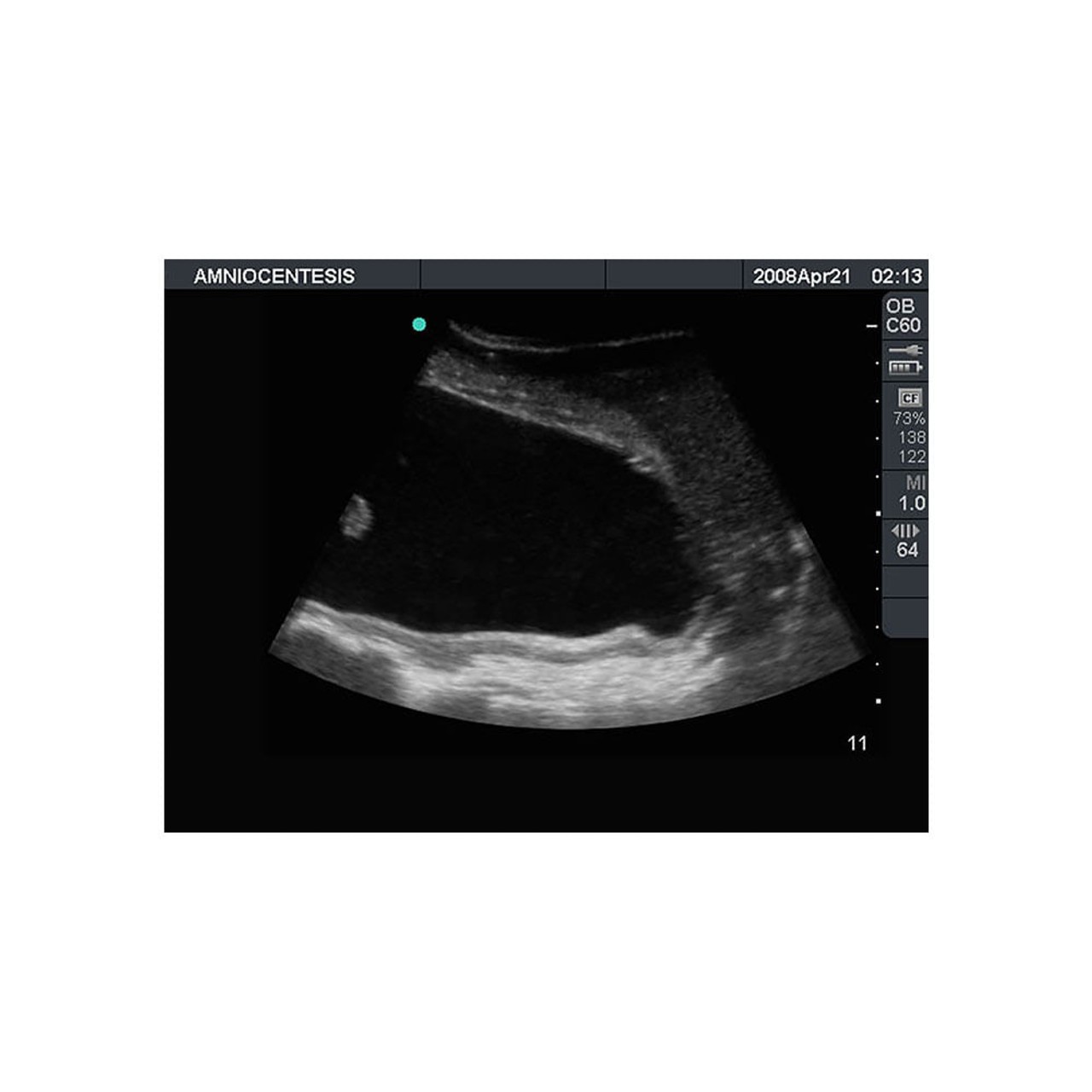 Percutaneous Umbilical Cord Blood Sampling Ultrasound Training Model