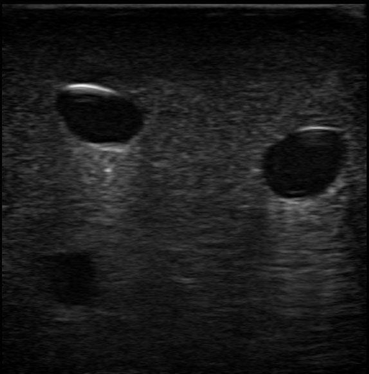 Gen II PICC with IV and Arterial Line Vascular Access Ultrasound Trainer