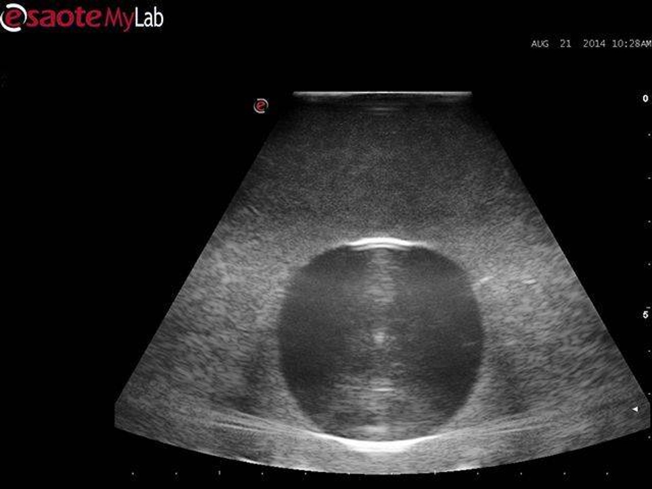 Abscess Drainage Ultrasound Training Model