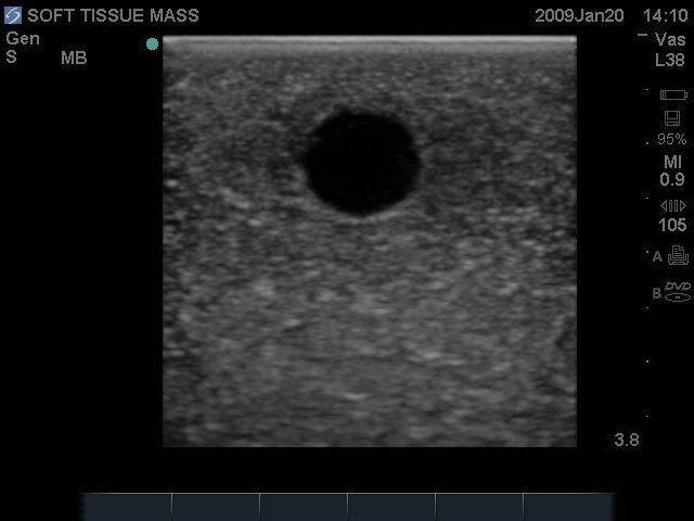 Breast Biopsy Ultrasound Training Model