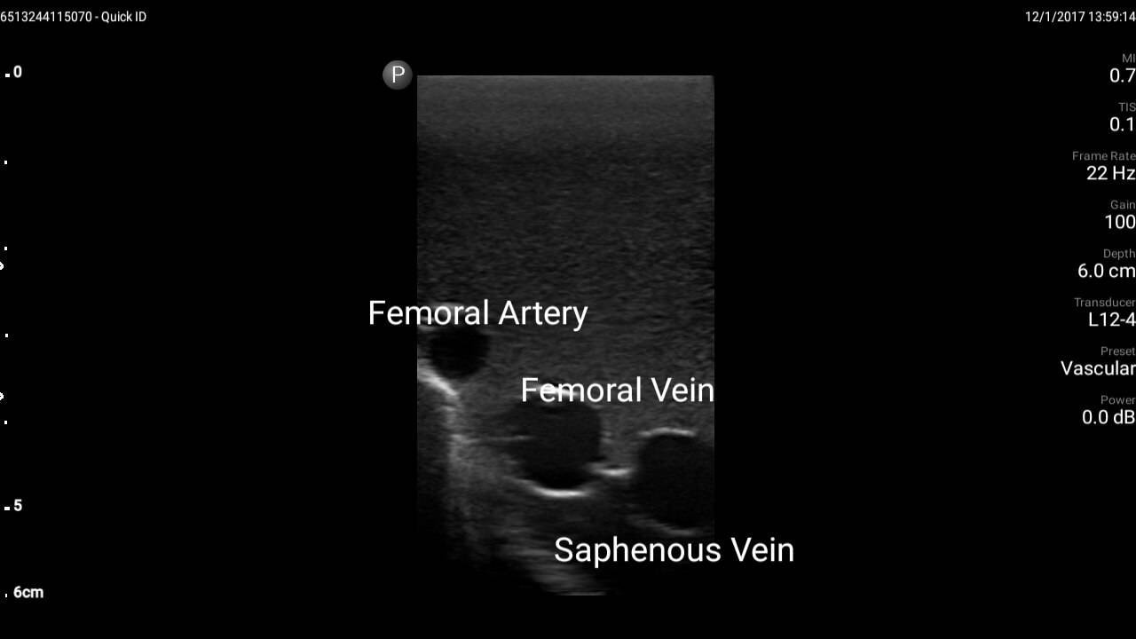 Gen II Femoral Vascular Access and Regional Anesthesia Ultrasound Training Model