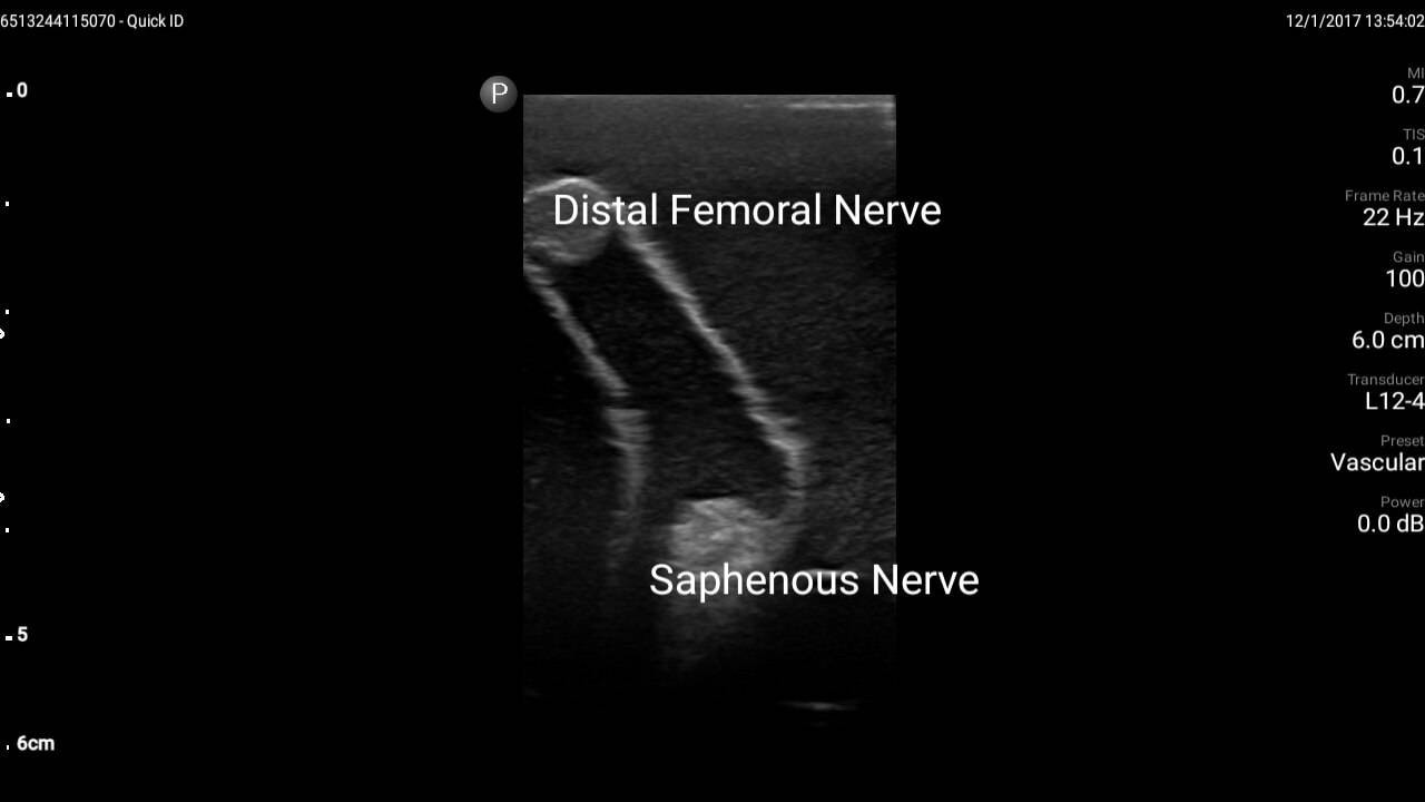 Gen II Femoral Vascular Access and Regional Anesthesia Ultrasound Training Model