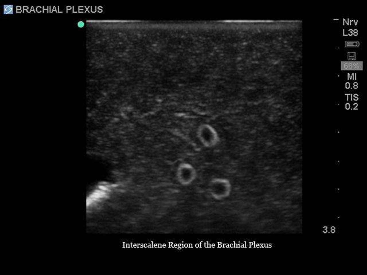 Gen II Brachial Plexus Block and Ultrasound Central Line Replacement Tissue Insert