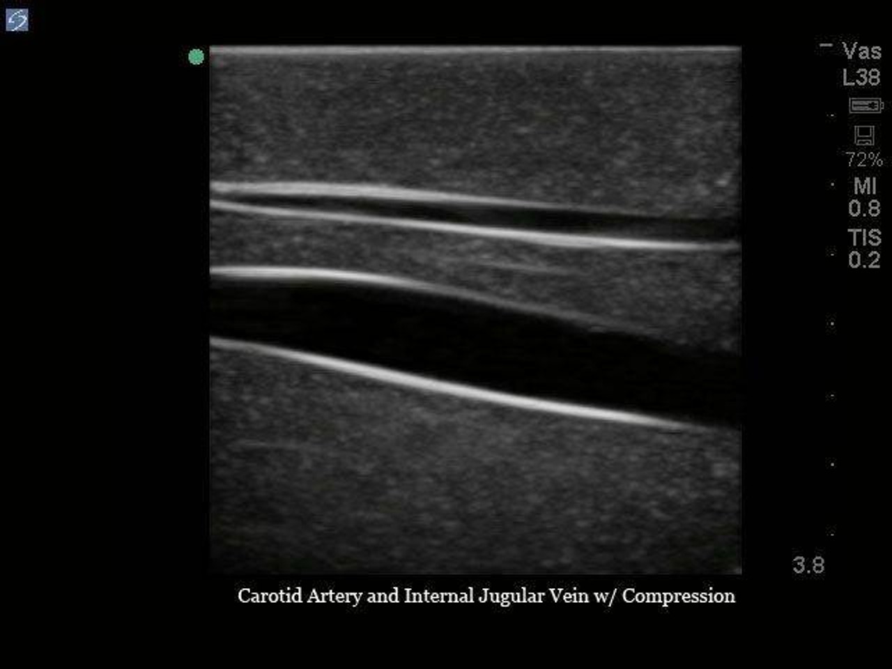 Internal Jugular Central Line Ultrasound Manikin