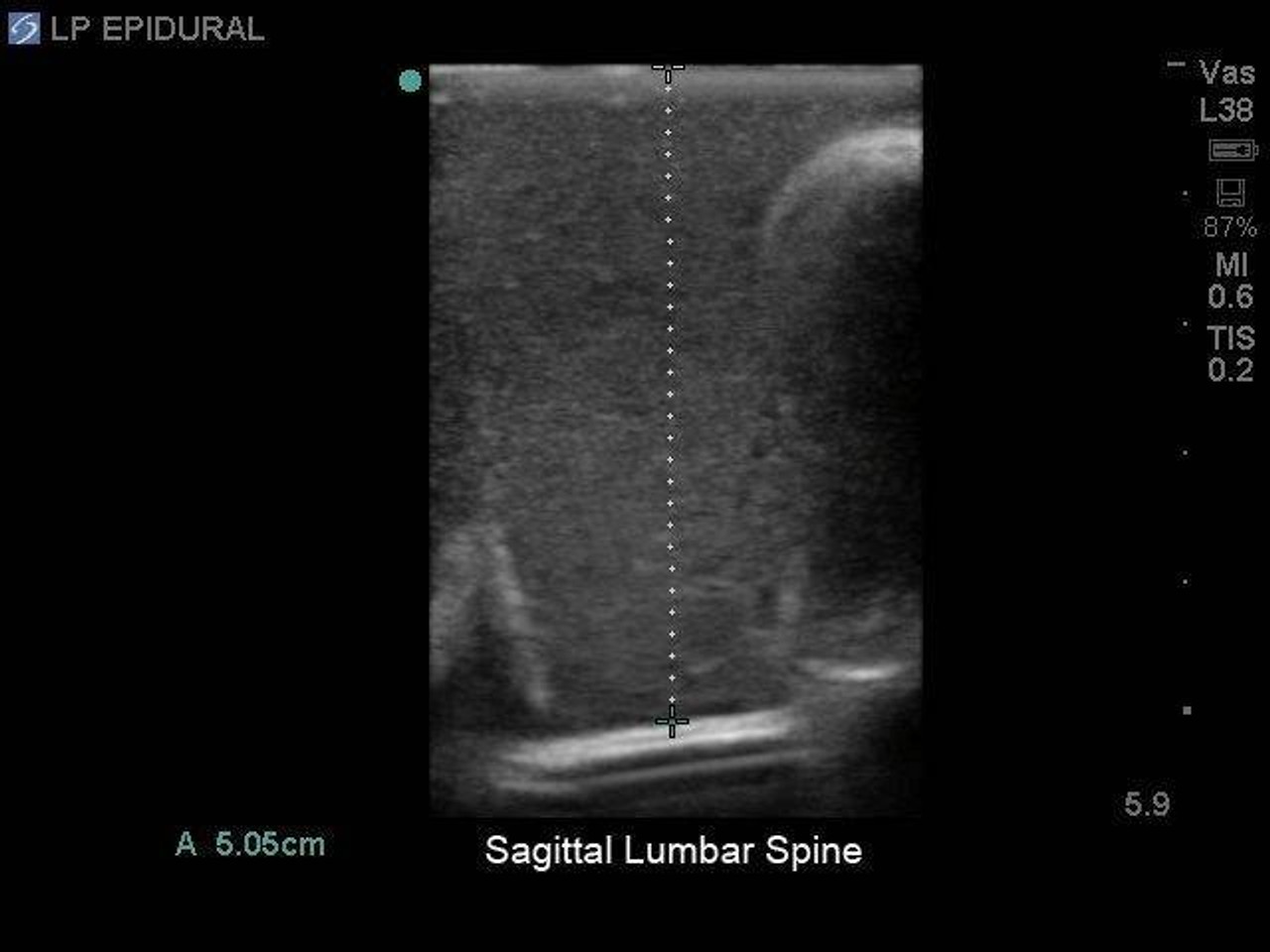 Lumbar Puncture and Spinal Epidural Training Model