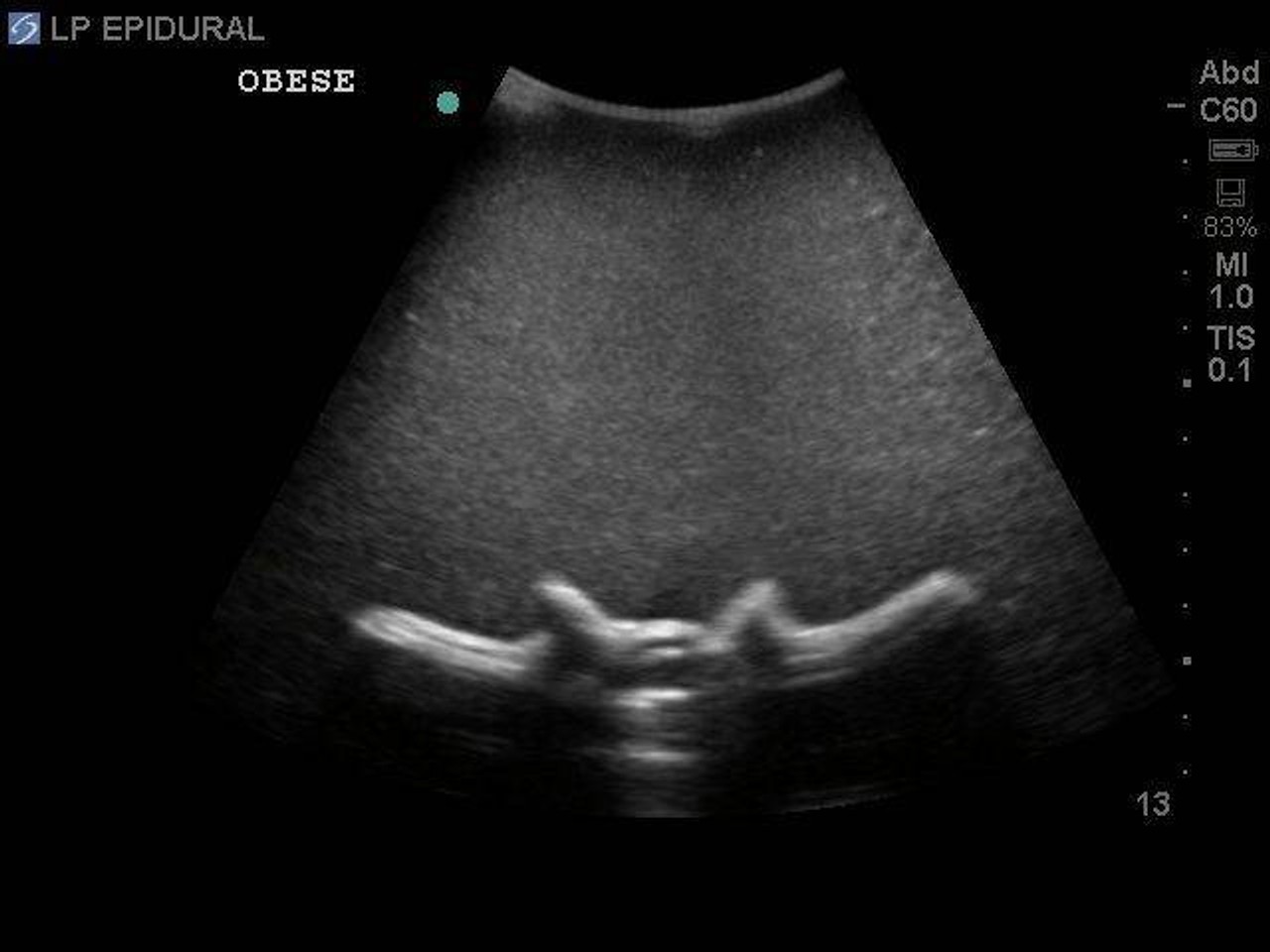 Lumbar Puncture and Spinal Epidural Replacement Tissue