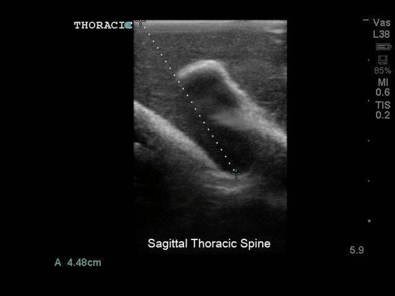 Lumbar Puncture and Spinal Epidural Replacement Tissue