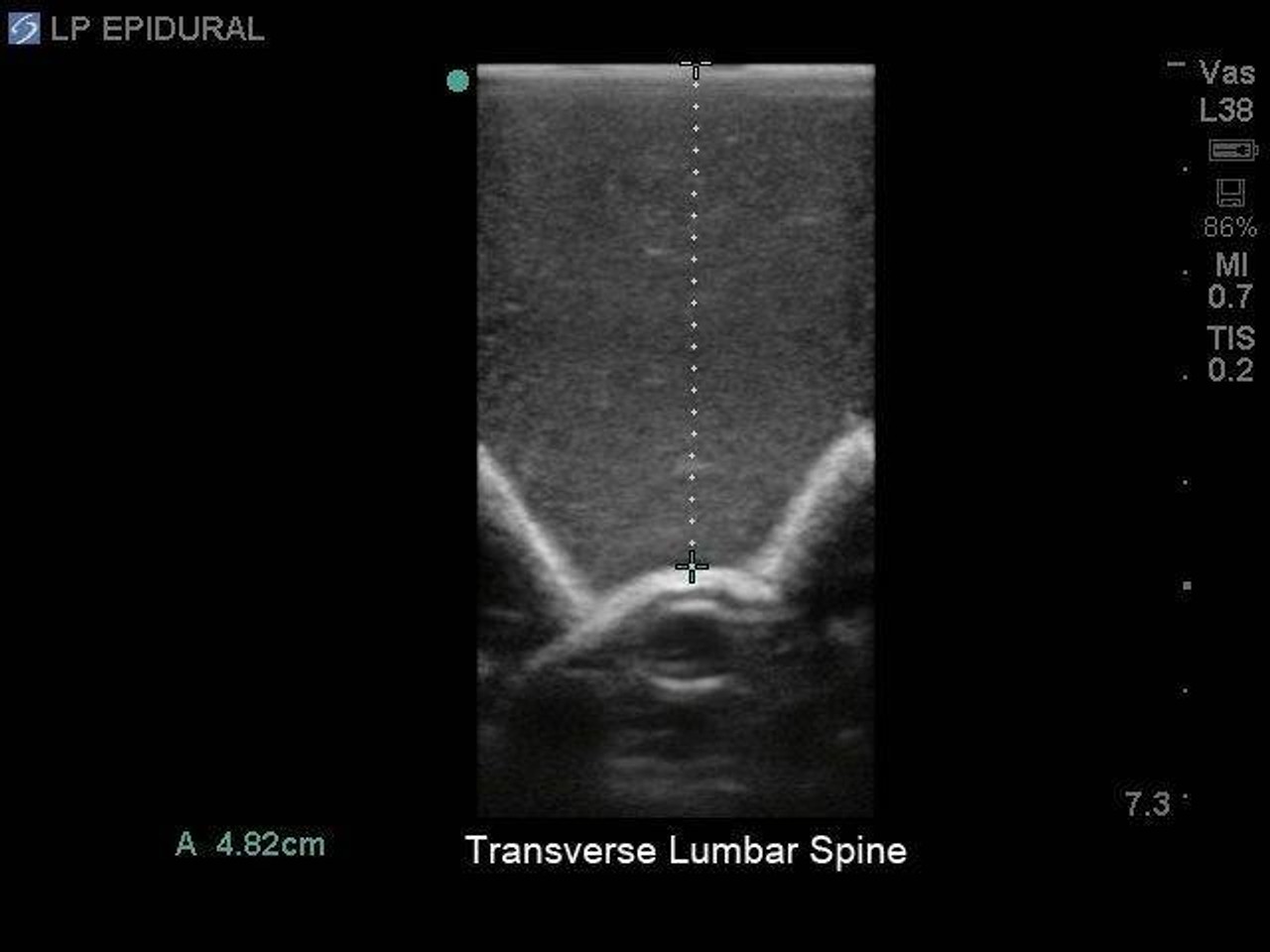 Lumbar Puncture and Spinal Epidural Replacement Tissue