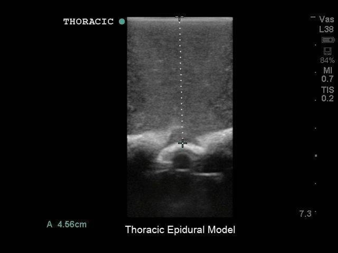 Lumbar Puncture and Spinal Epidural Replacement Tissue