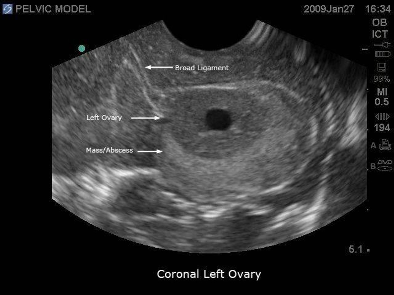 General Pathology Transvaginal Ultrasound Training Model