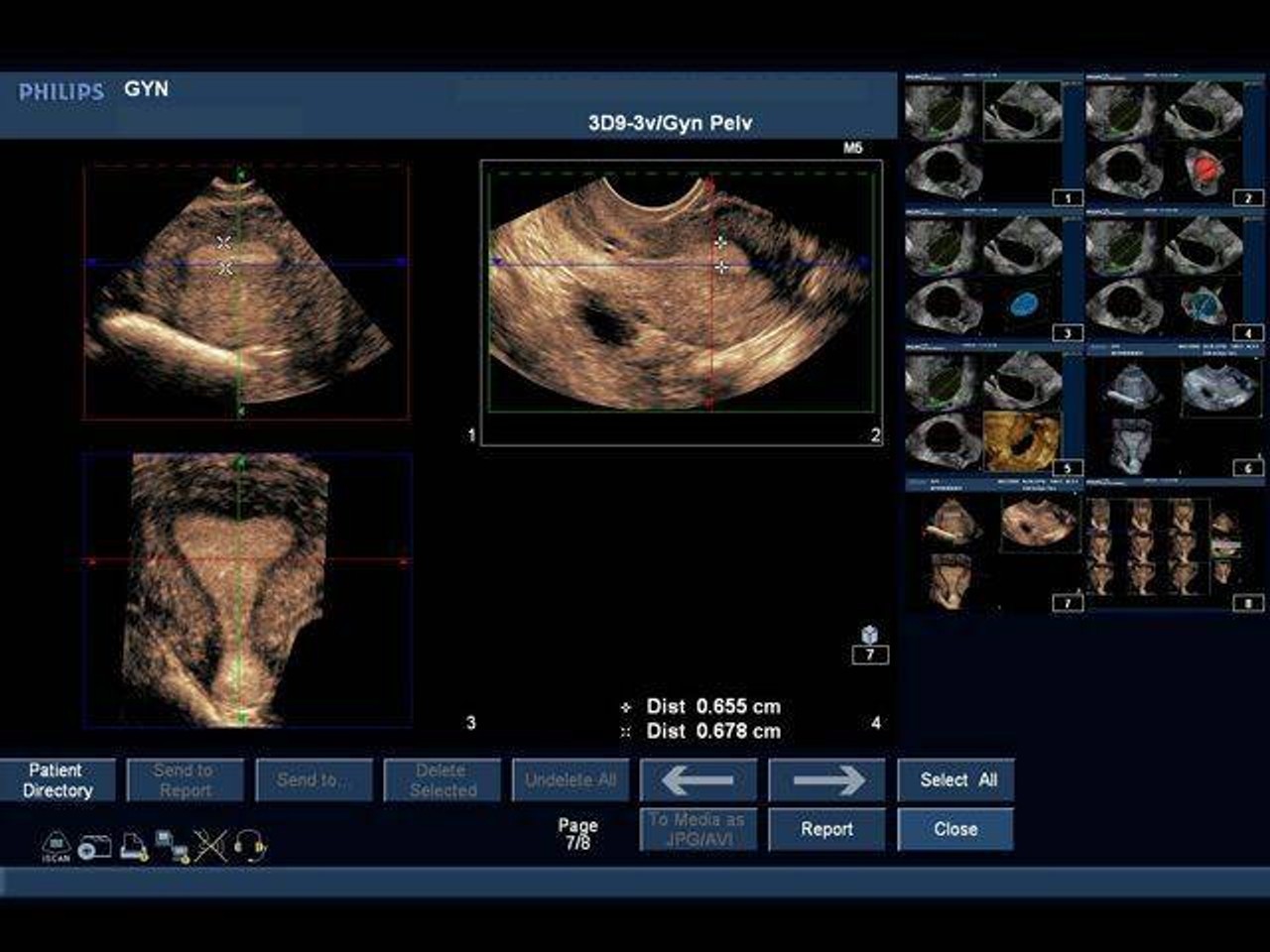 General Pathology Transvaginal Ultrasound Training Model