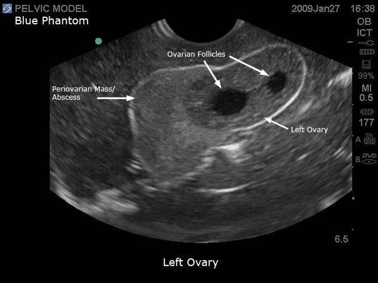 General Pathology Transvaginal Ultrasound Training Model