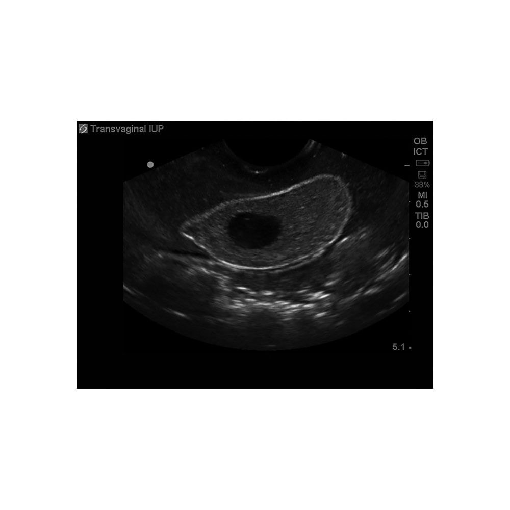 General Pathology Transvaginal Ultrasound Training Model