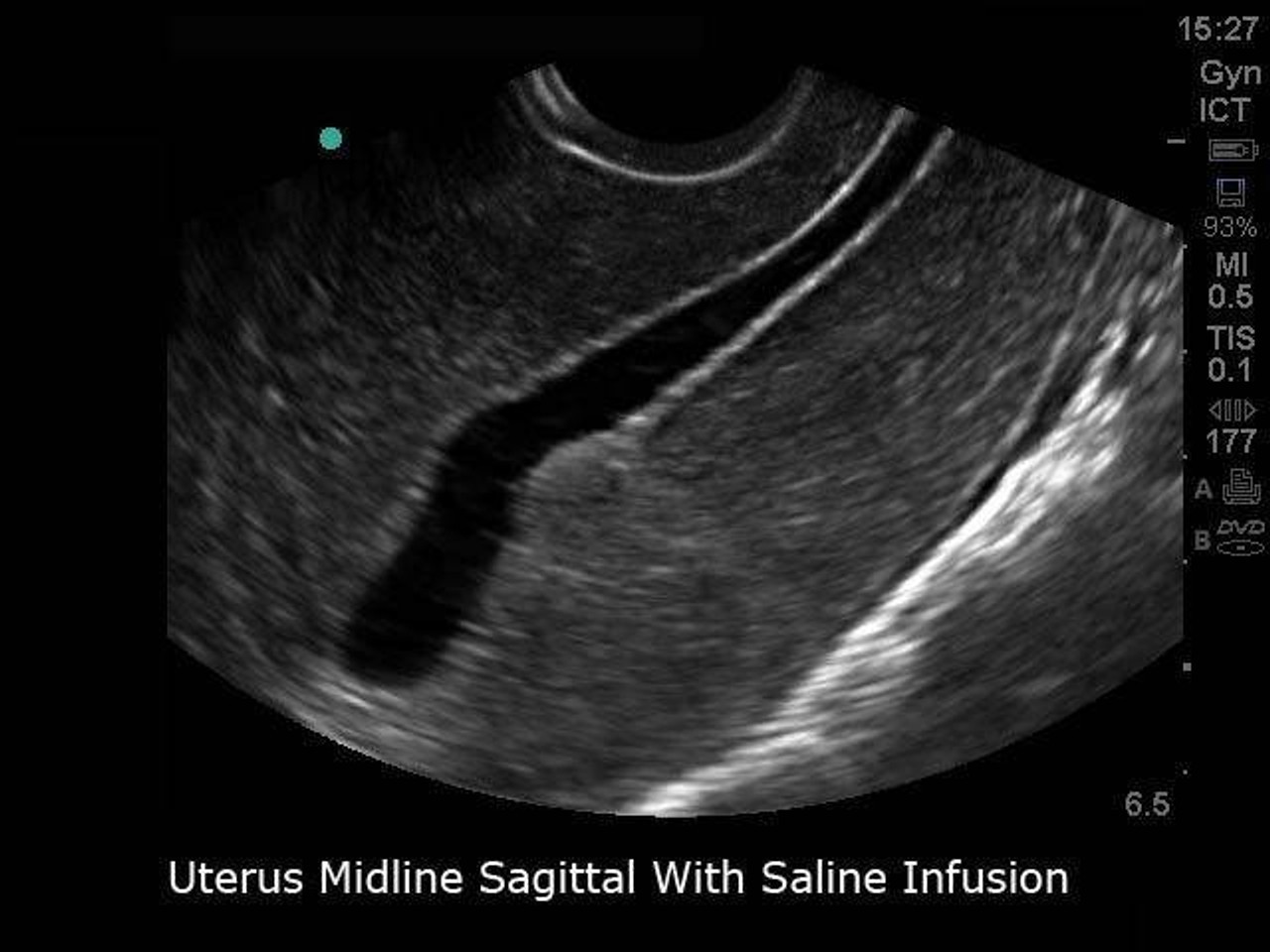 Transvaginal SonoHysterography and Sonosalpingography Ultrasound Training Model
