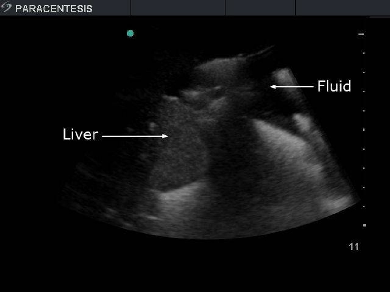 Paracentesis Ultrasound Replacement Tissue Insert