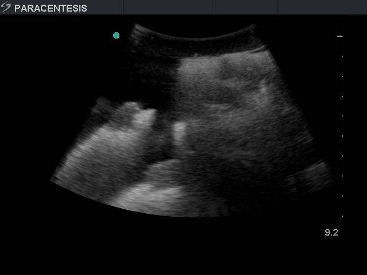 Paracentesis Ultrasound Replacement Tissue Insert