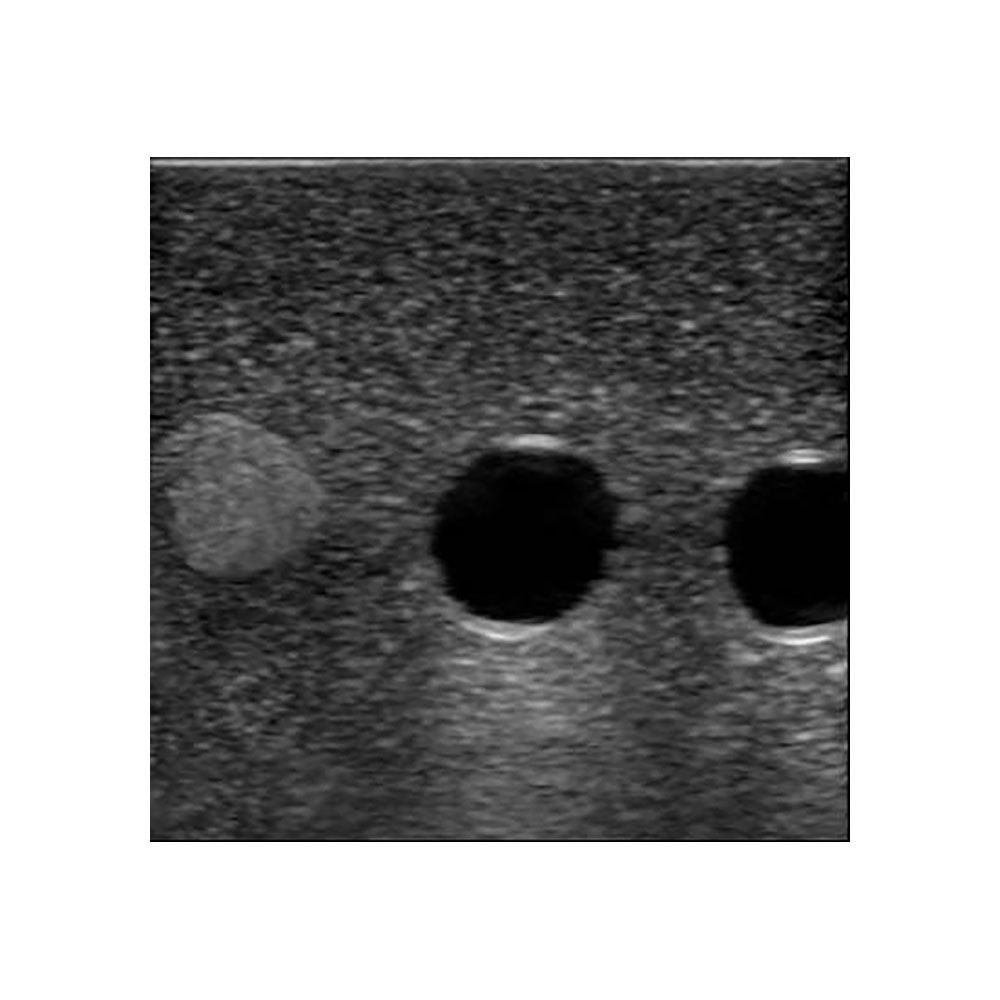 Paracentesis Ultrasound Replacement Tissue Insert