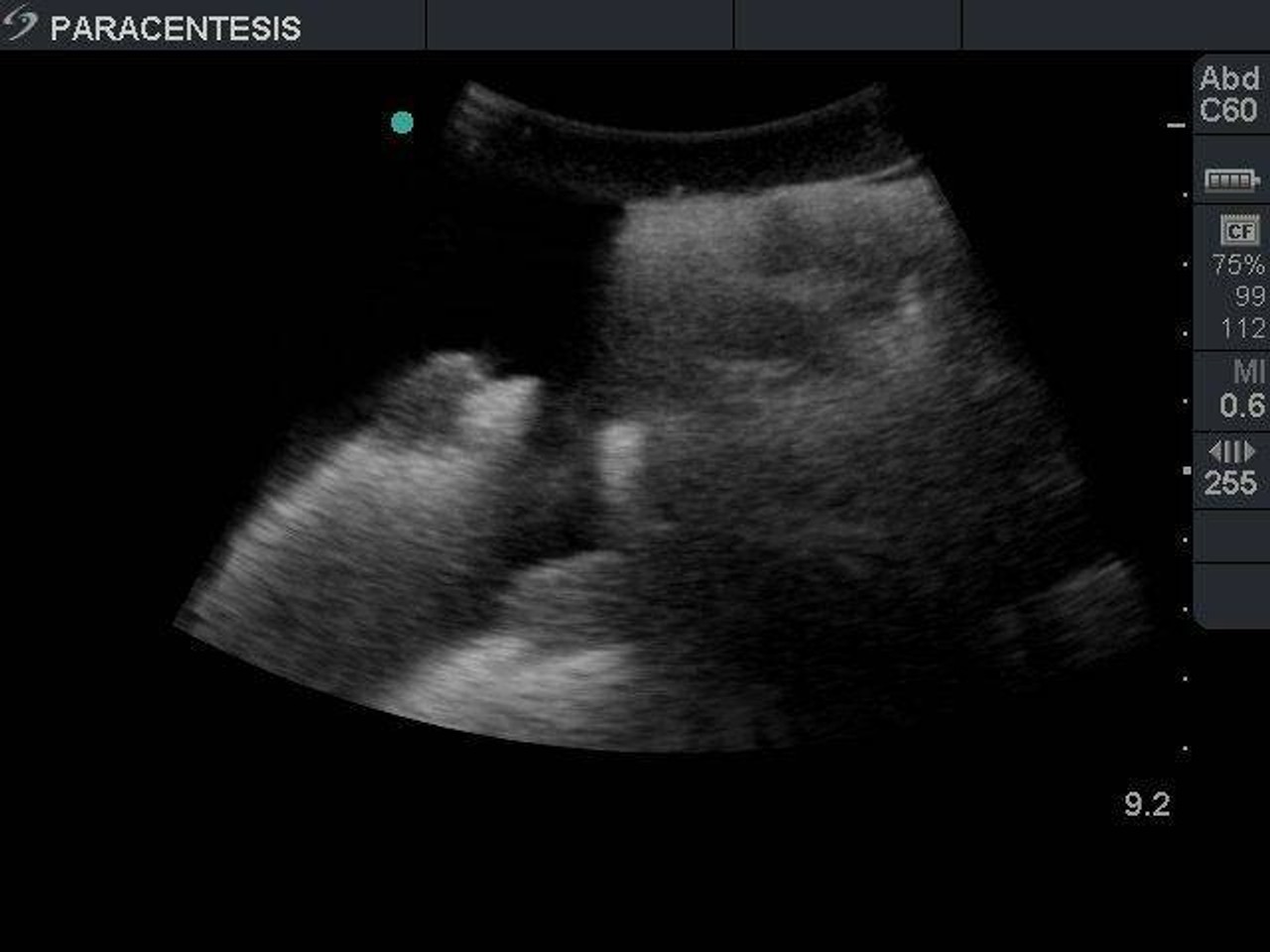 Paracentesis Ultrasound Training Model