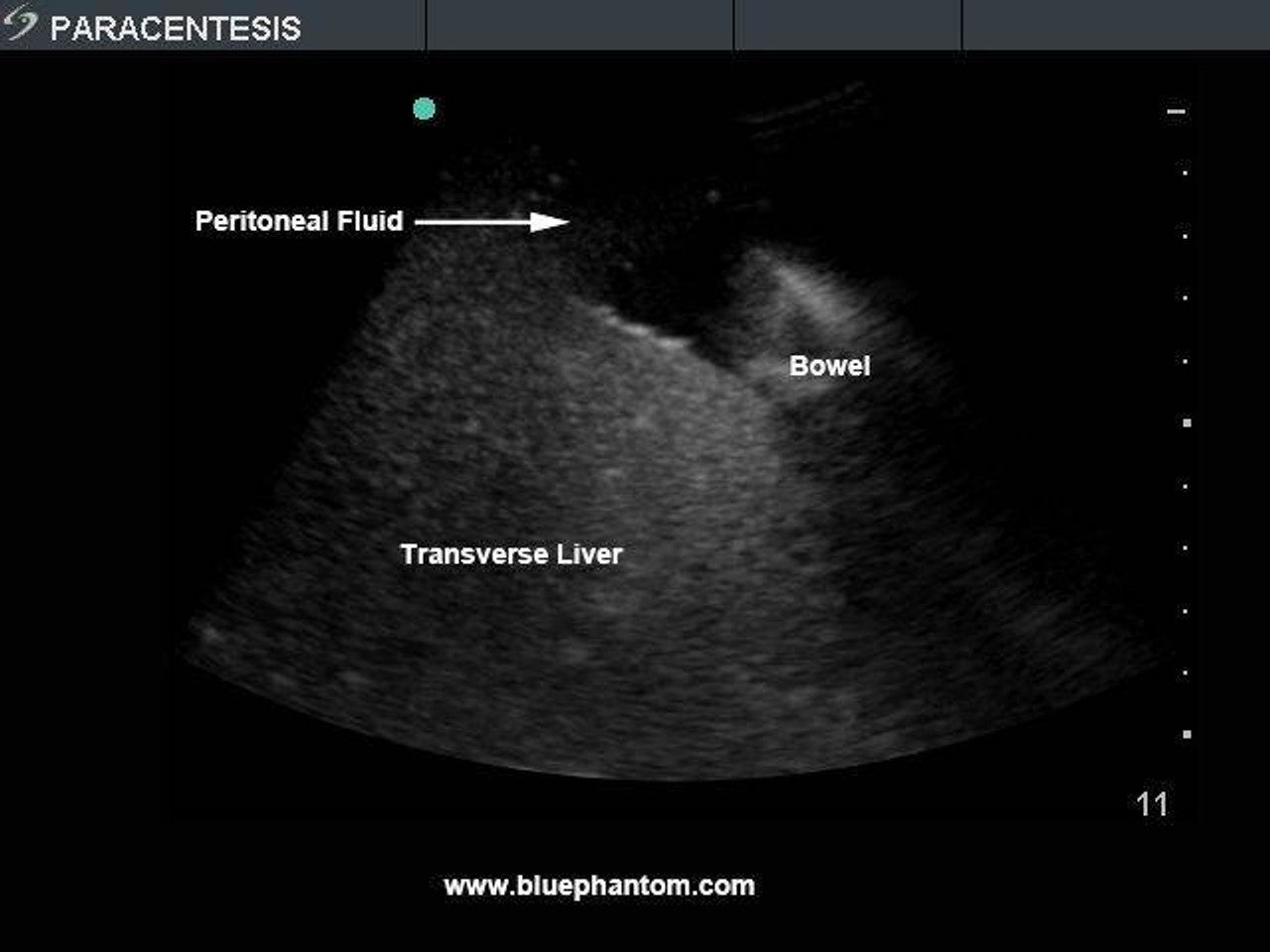 Paracentesis Ultrasound Training Model