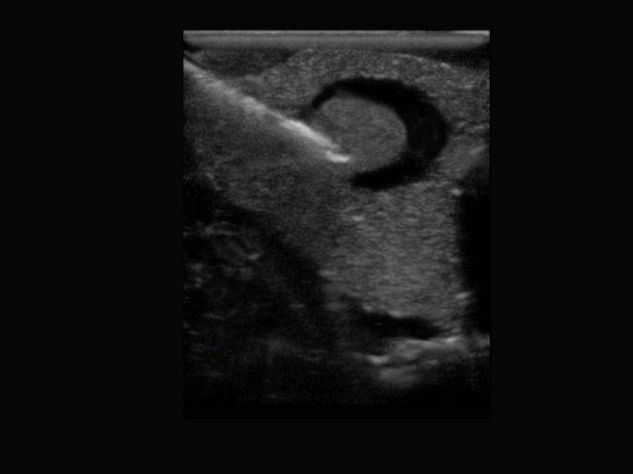 Thyroid Biopsy Ultrasound Training Model
