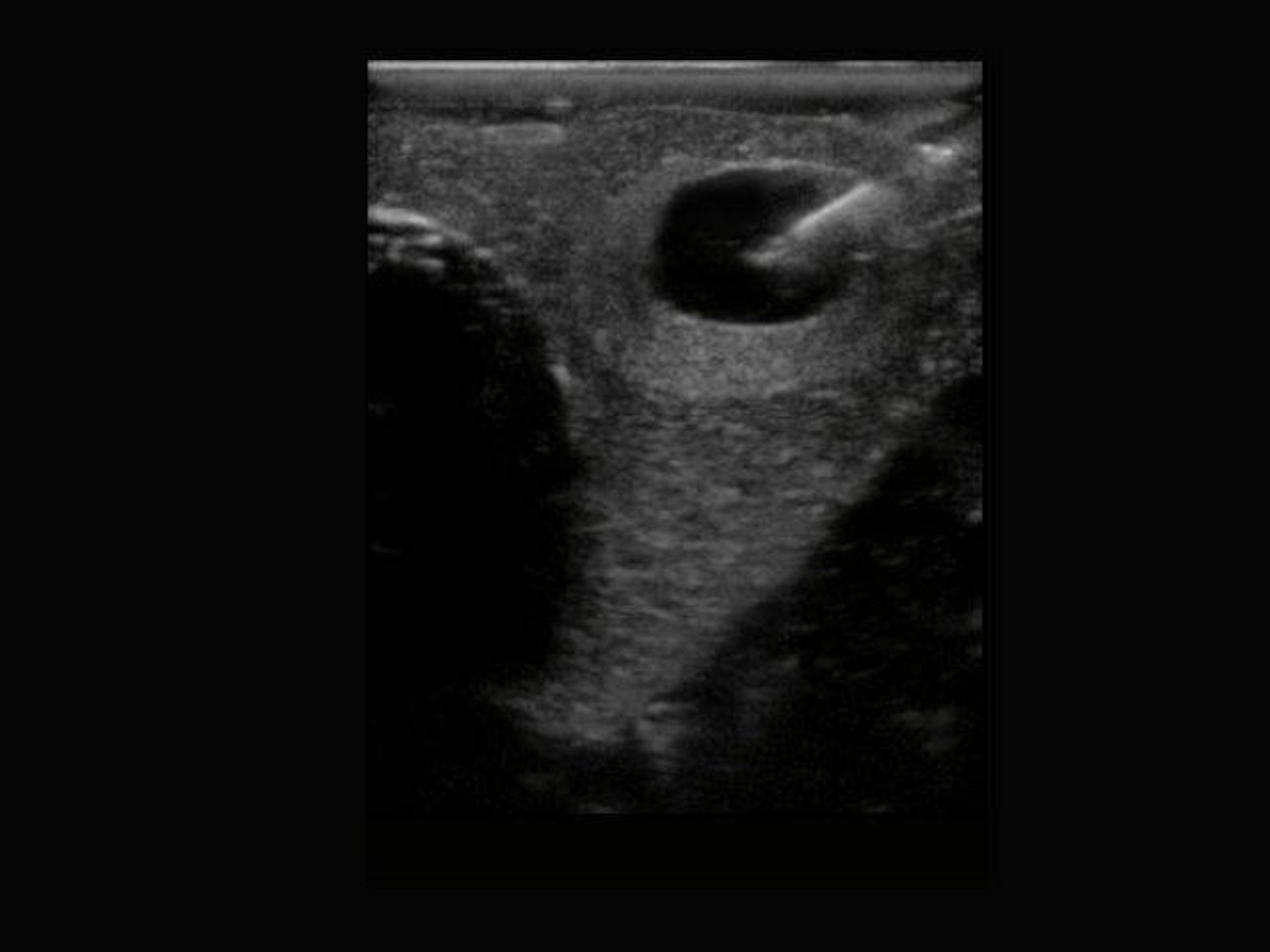 Thyroid Biopsy Ultrasound Training Model