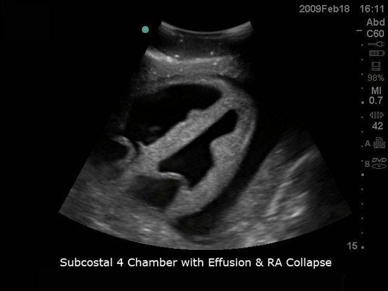 Transesophageal Echo and Transthoracic Echo Training Model