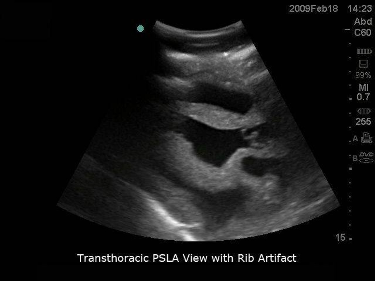 Transesophageal Echo and Transthoracic Echo Training Model