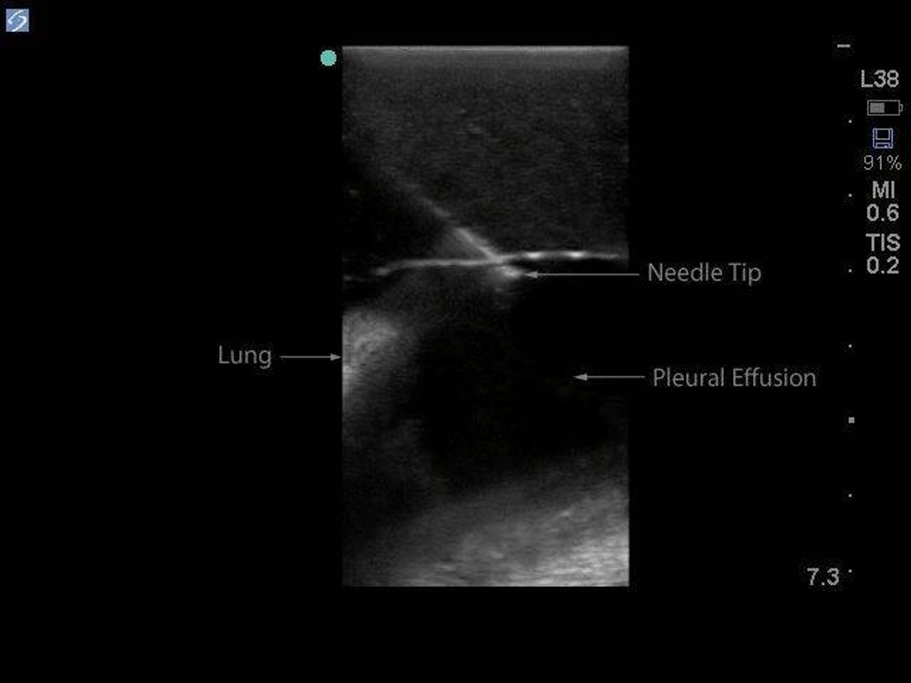 Midscapular Thoracentesis Ultrasound Training Model