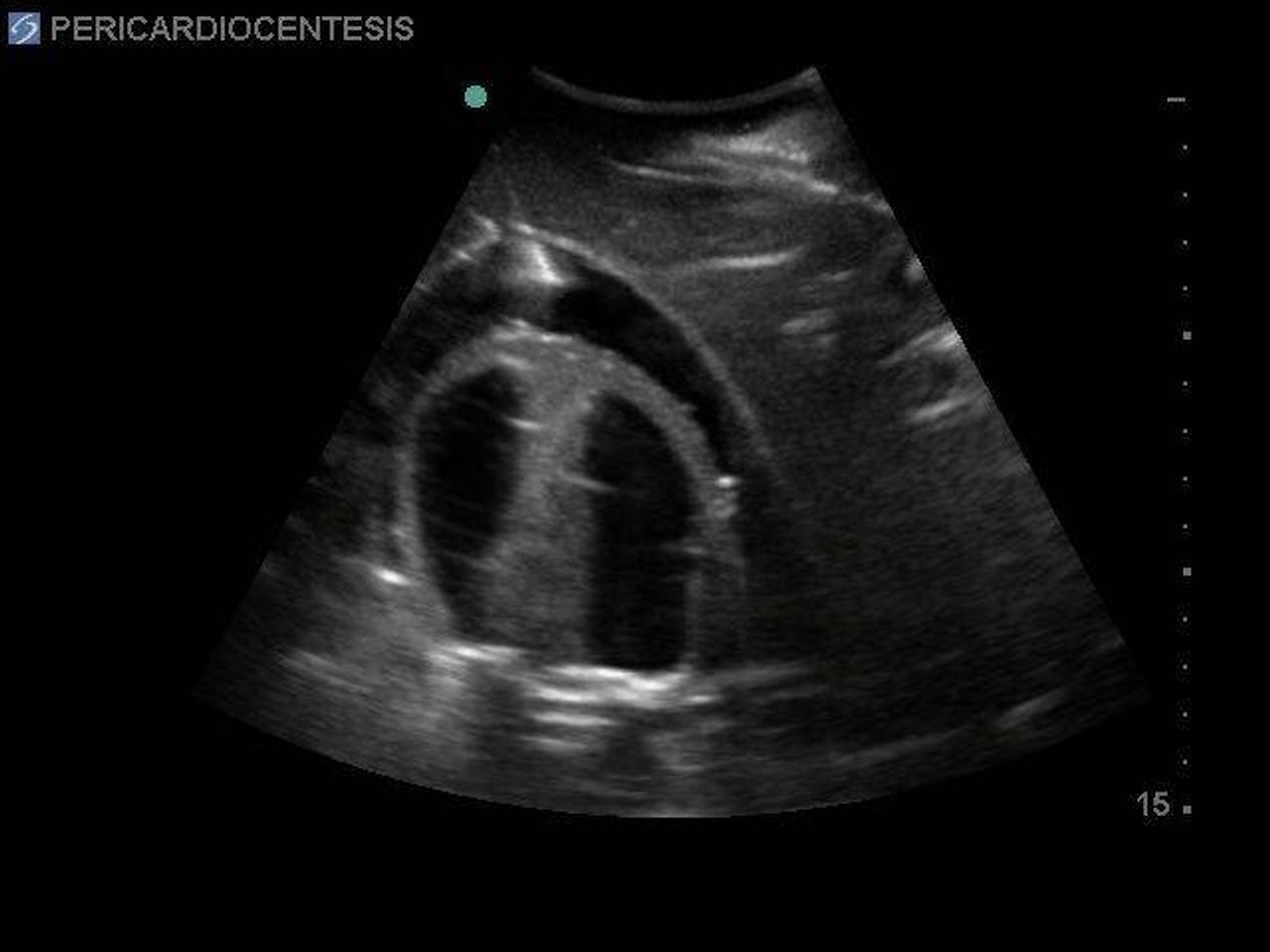 Transthoracic Echocardiography and Pericardiocentesis Ultrasound Training Model