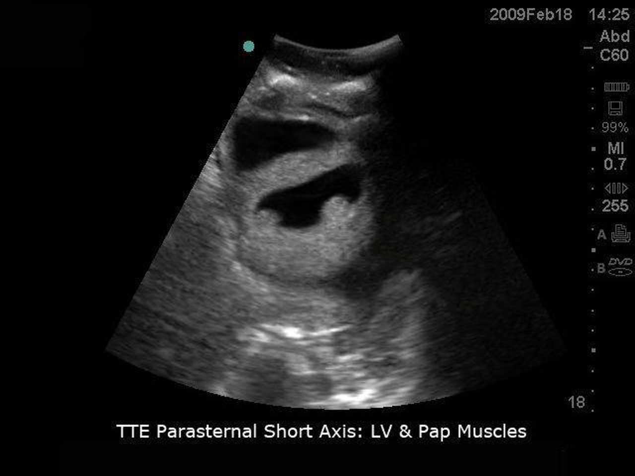Transthoracic Echocardiography and Pericardiocentesis Ultrasound Training Model
