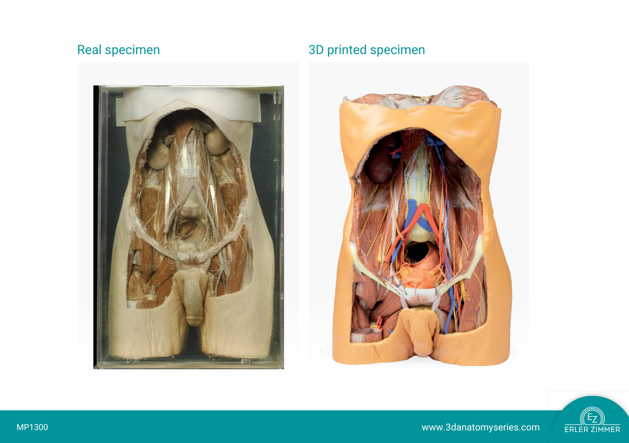 3D Printed Posterior Abdominal wall