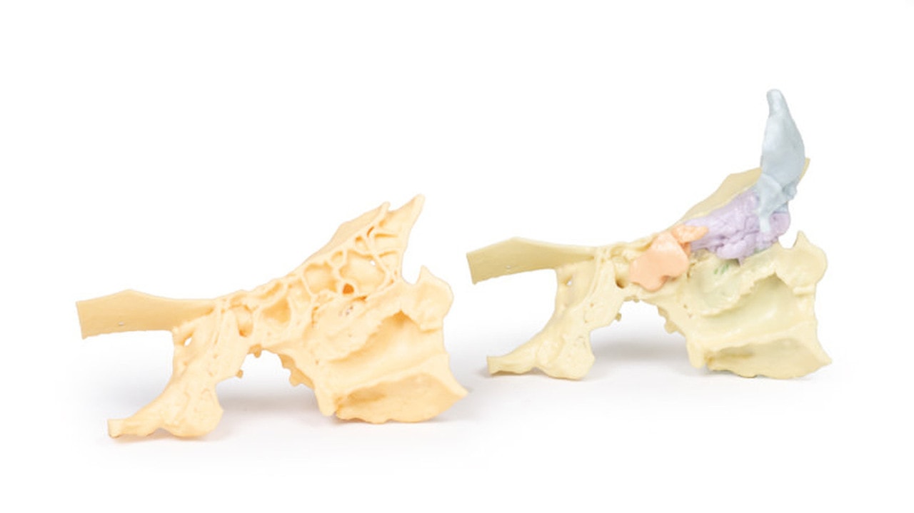3D Printed Paranasal Sinus Model