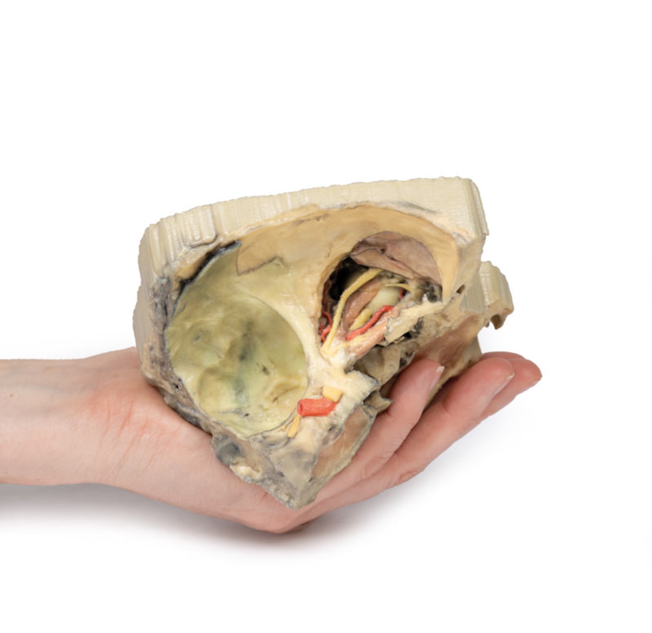 3D Printed Medial Orbit