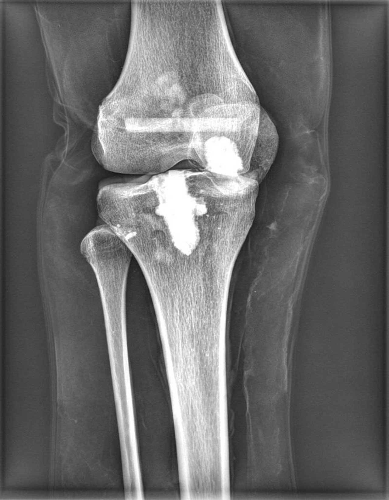 Full Body X-Ray Phantom With Real Human Skeleton Bones