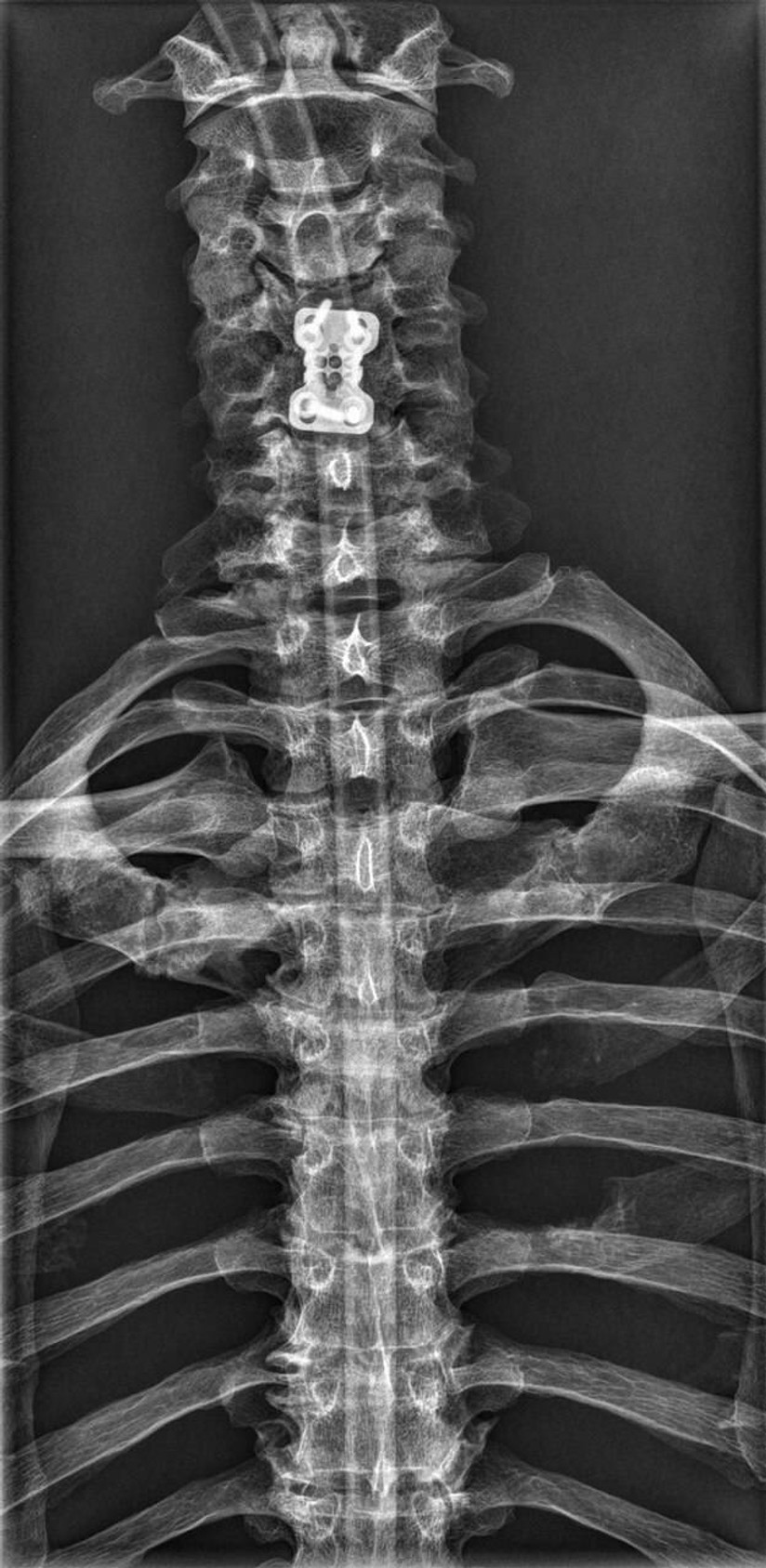 Full Body X-Ray Phantom With Real Human Skeleton Bones