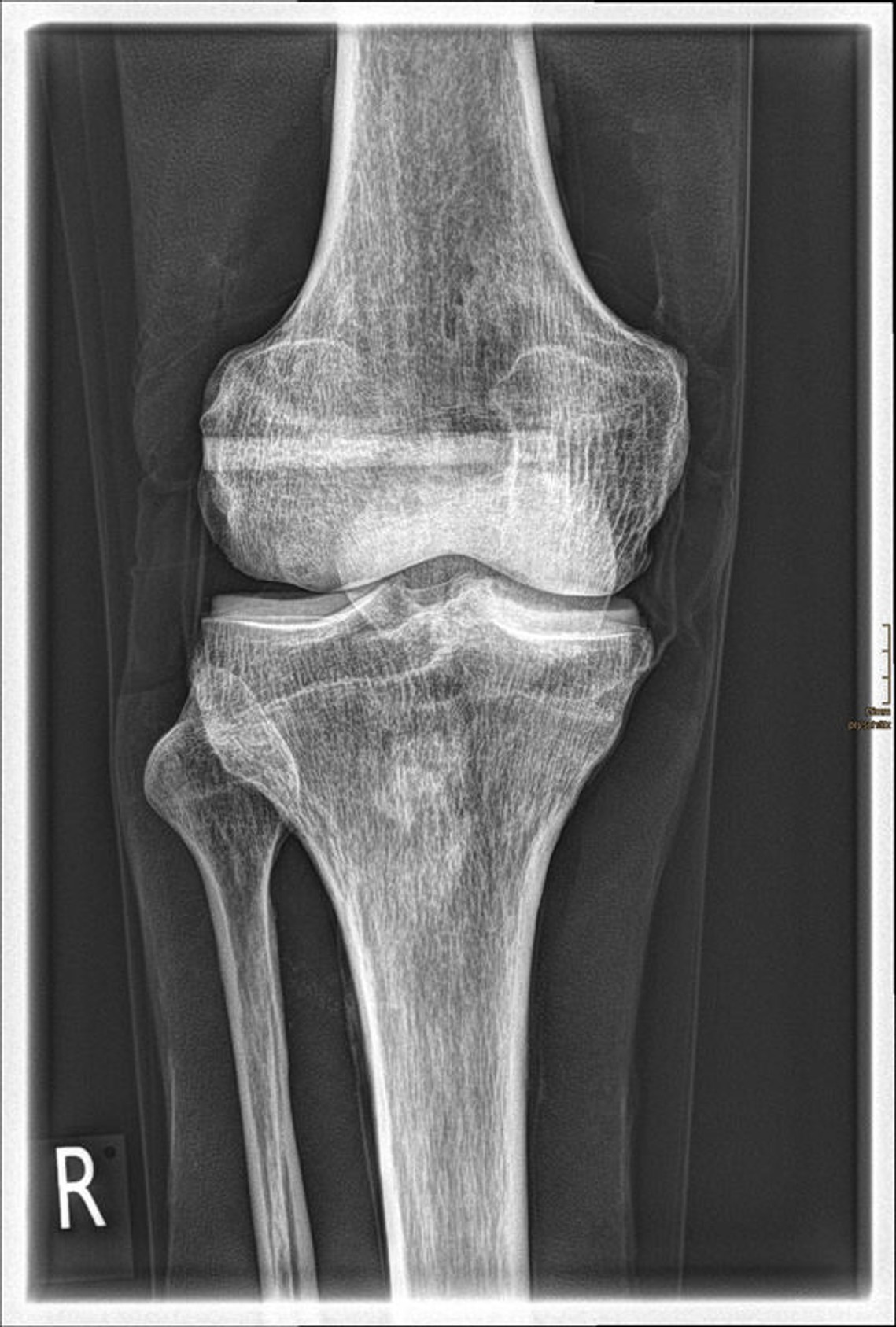 Full Body X-Ray Phantom With Real Human Skeleton Bones