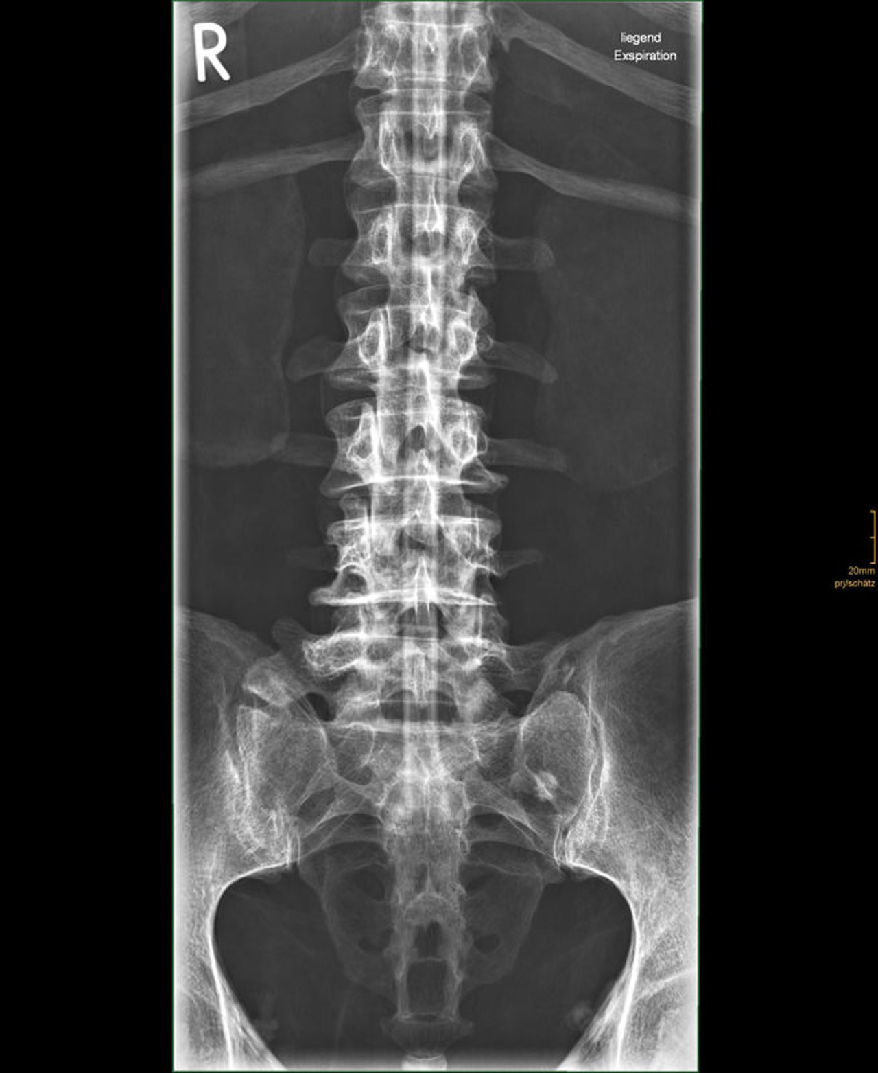 Full Body X-Ray Phantom With Real Human Skeleton Bones