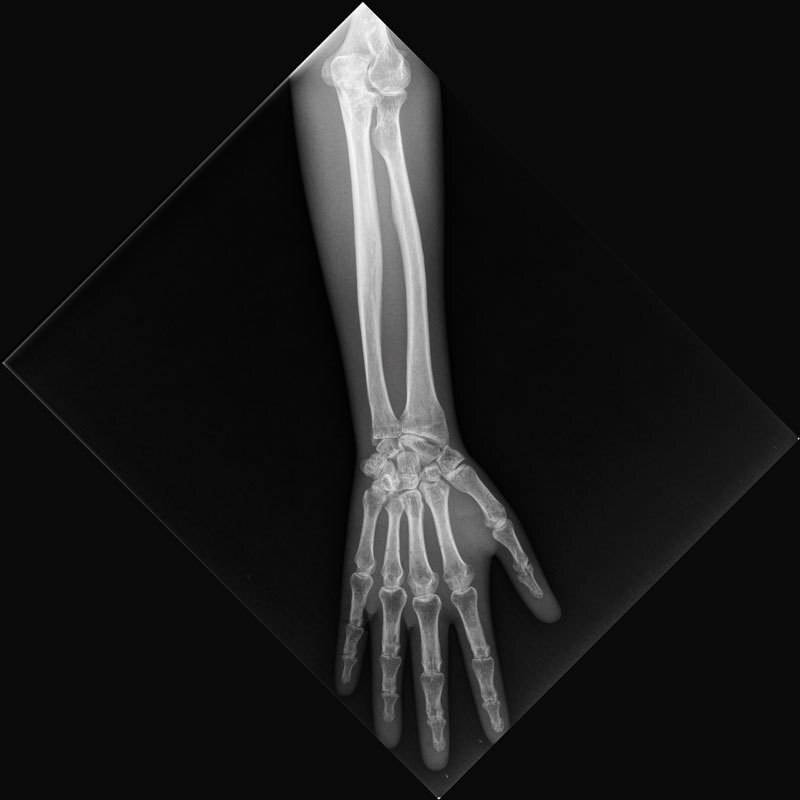 Erler-Zimmer X-Ray Phantom Lower Arm, Transparent | Anatomy Warehouse