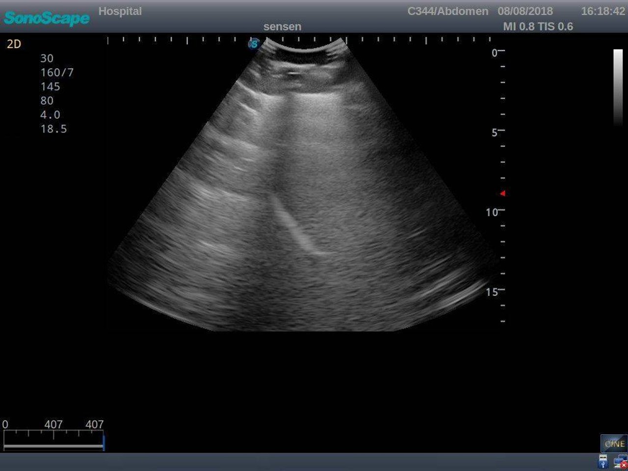 Anatomy Lab Thoracentesis Ultrasound Training Model