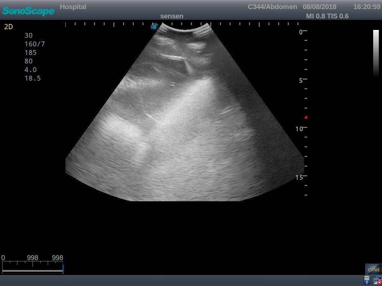 Anatomy Lab Thoracentesis Ultrasound Training Model