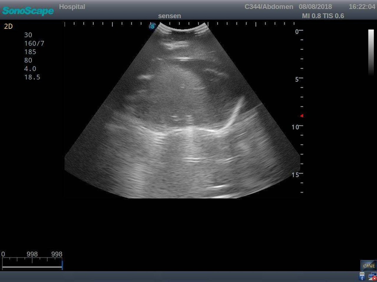 Anatomy Lab Thoracentesis Ultrasound Training Model