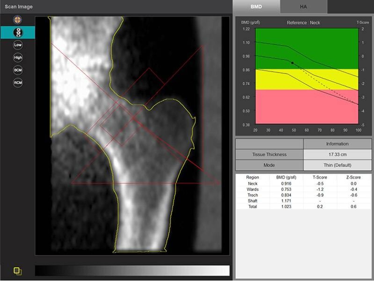 X-Ray Phantom Pelvis, Transparent