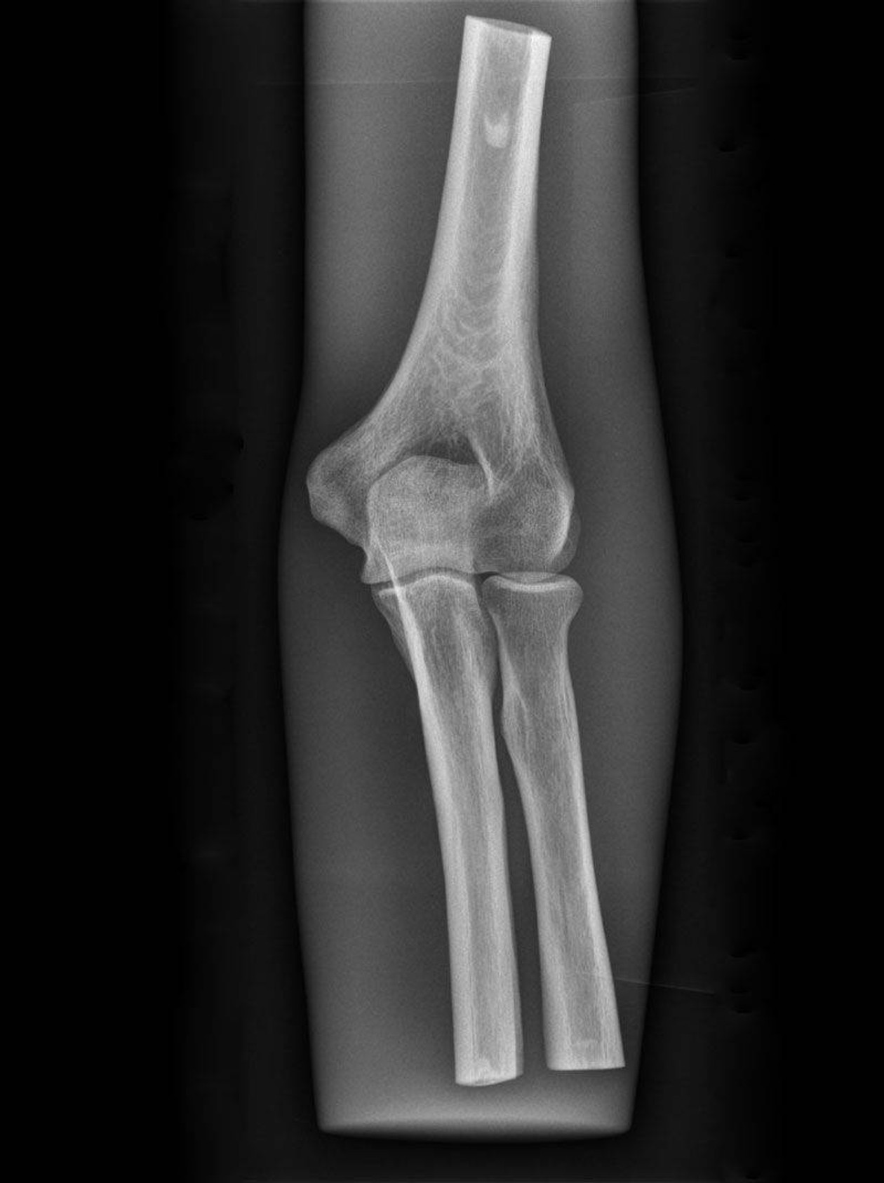 X-Ray Phantom Elbow, Opaque - Carrying Case