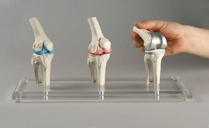 Erler-Zimmer Knee Implant Model | Anatomy Warehouse