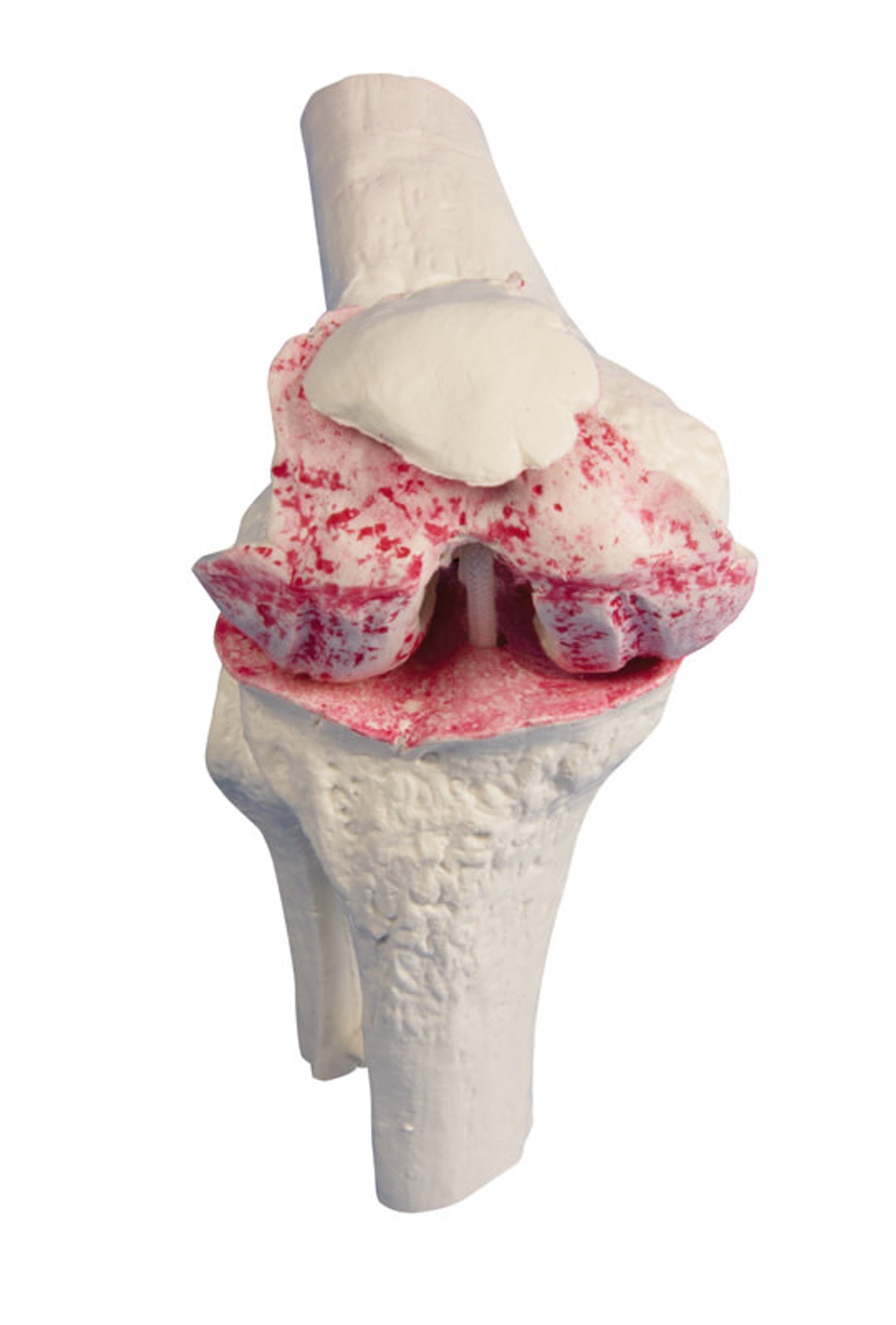 Knee Implant Model