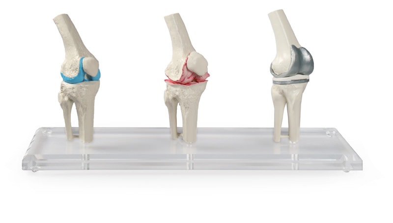 Erler-Zimmer Knee Implant Model | Anatomy Warehouse