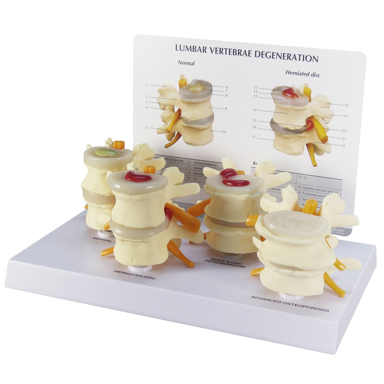 Four Stage Vertebrae Set Anatomy Model