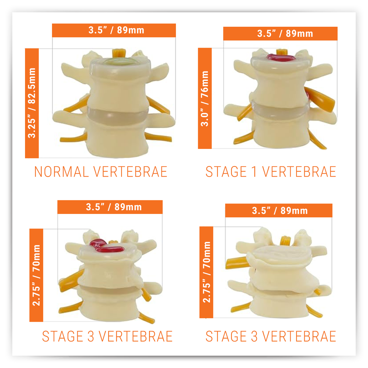 Four Stage Vertebrae Set Anatomy Model